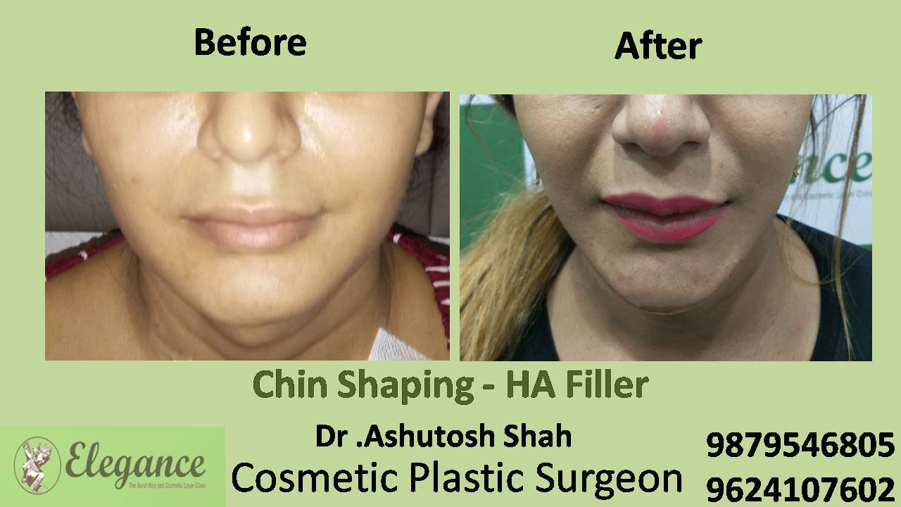 Chin Crease Fillers Treatment in Surat, Gujarat (India)