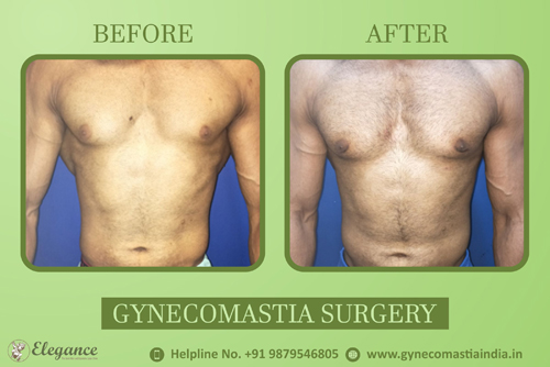 Adult Gynecomastia