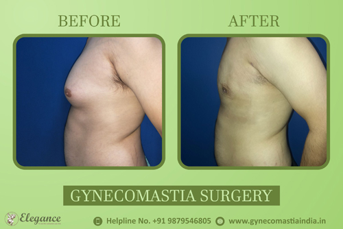 Male Nipple Reduction Gynecomastia