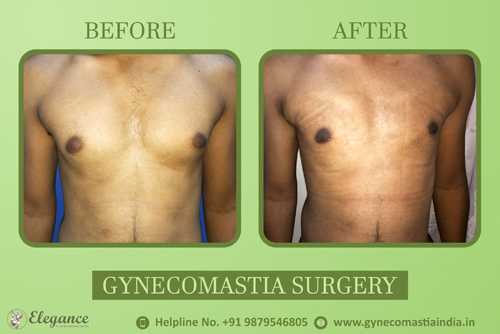 Neonatal Gynecomastia