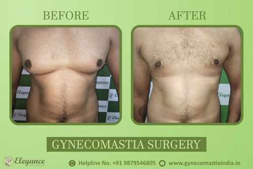 Neonatal Gynecomastia