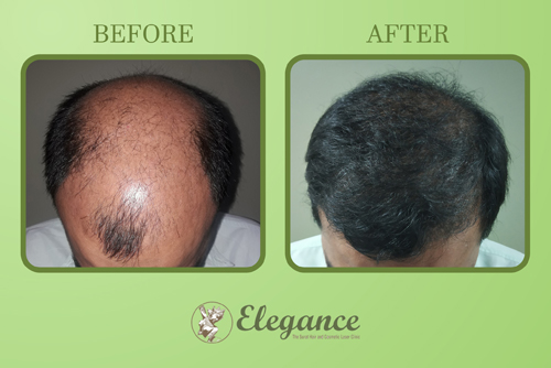 Body Hair Transplantation In Surat Gujarat India 4290