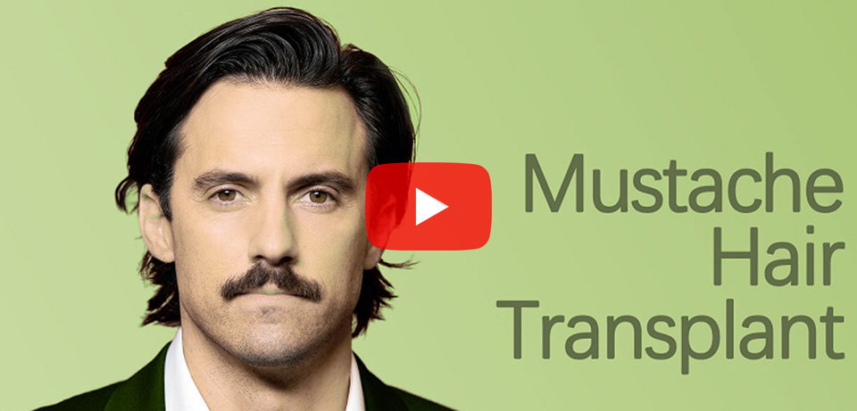 Mustache Hair Transplant in Surat, Gujarat (India)