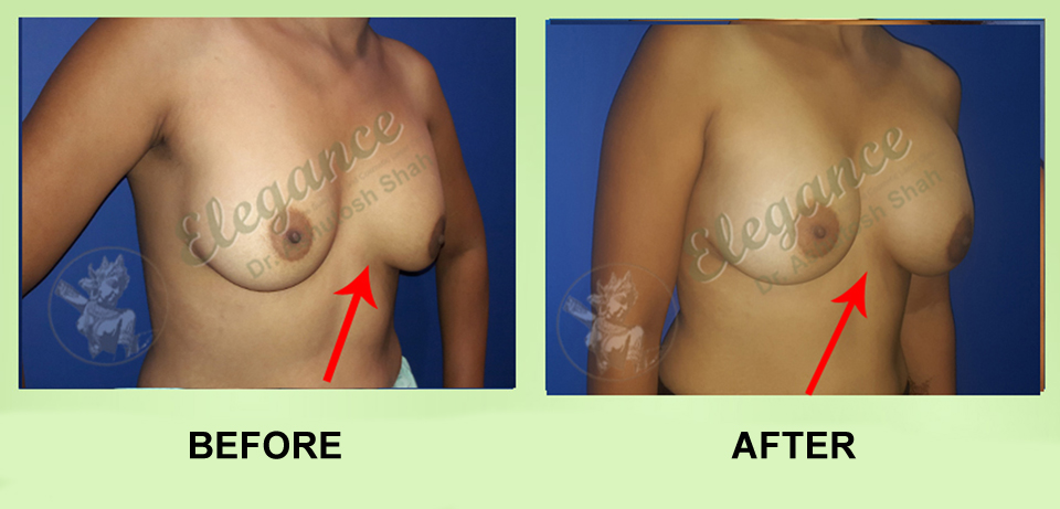 Fat Transfer For Breast Augmentation