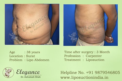 Lipo Dissolving Injections