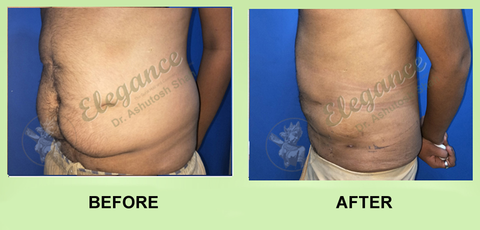 Post Bariatric Correction