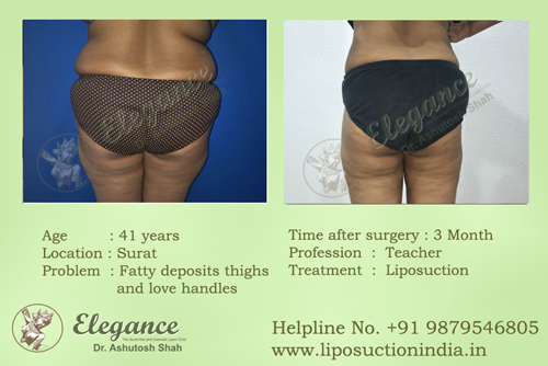 Post Bariatric Correction