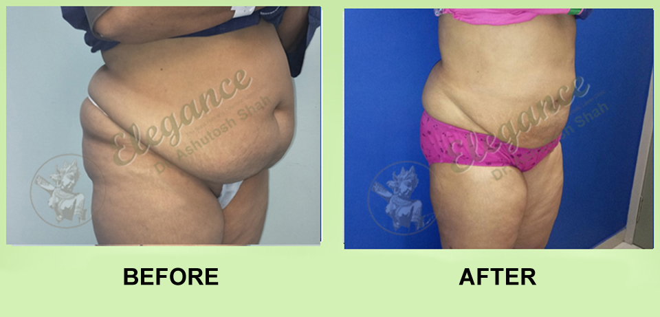 Tummy Tuck