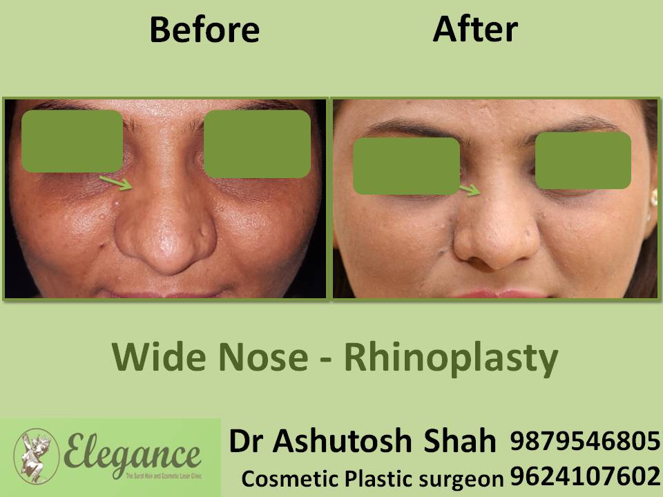 Non Surgical Rhinoplasty