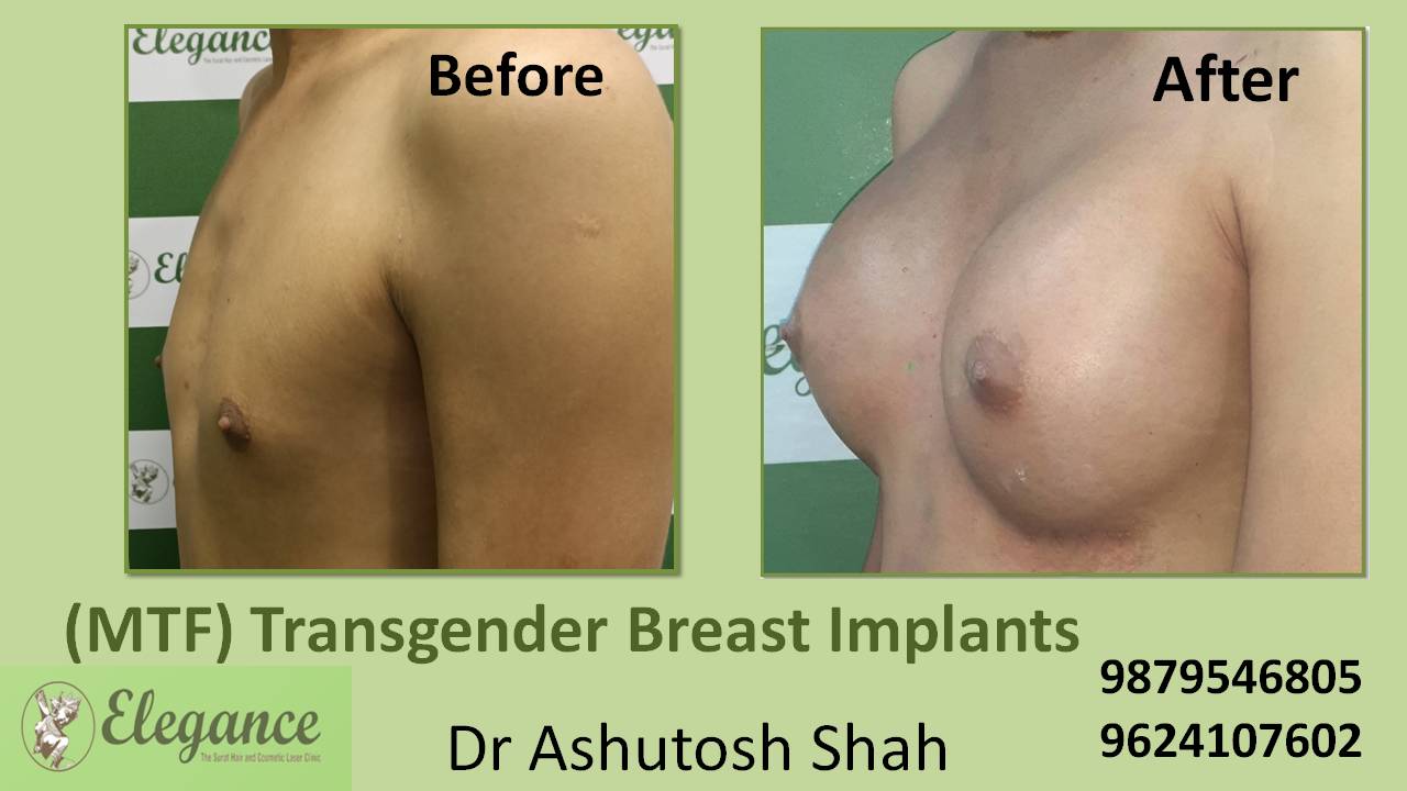 Transgender Male To Female Top Surgery