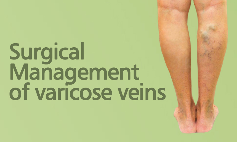 Surgical Management Of Varicose Veins 7614