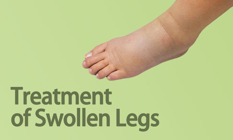 Treatment of Swollen Legs