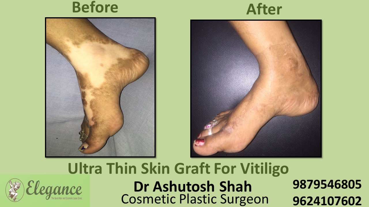 Ultrathin Skin Graft